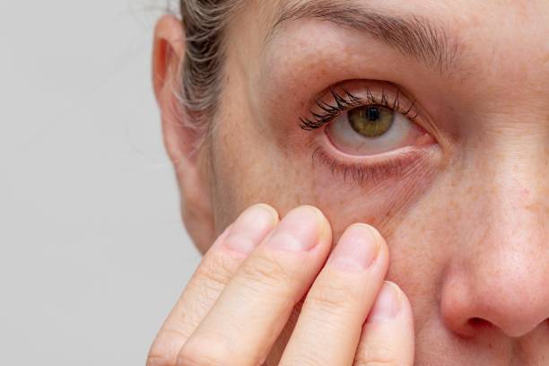 Dry Eye Syndrome: Symptoms and Treatments | Innovative Eye Care