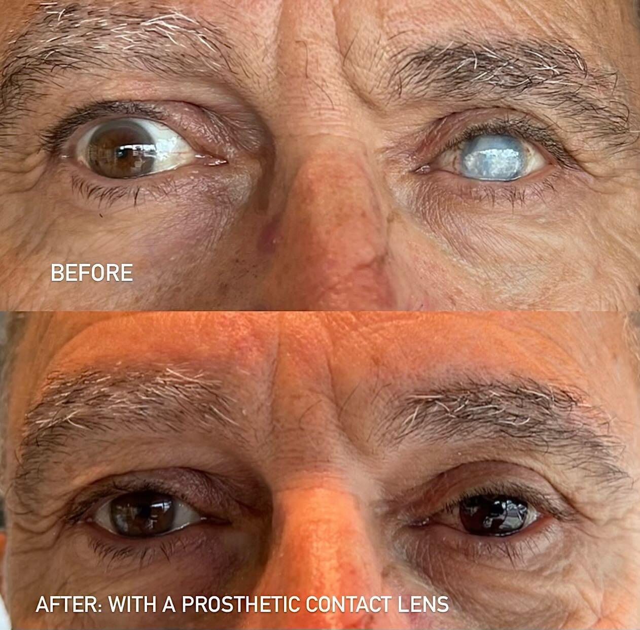 Vision correction treatment