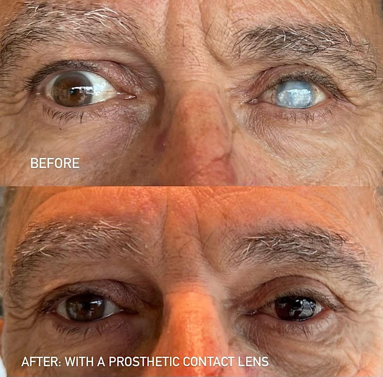 Before and after specialty contact lenses from the best optometrist near me in Charlotte, NC.